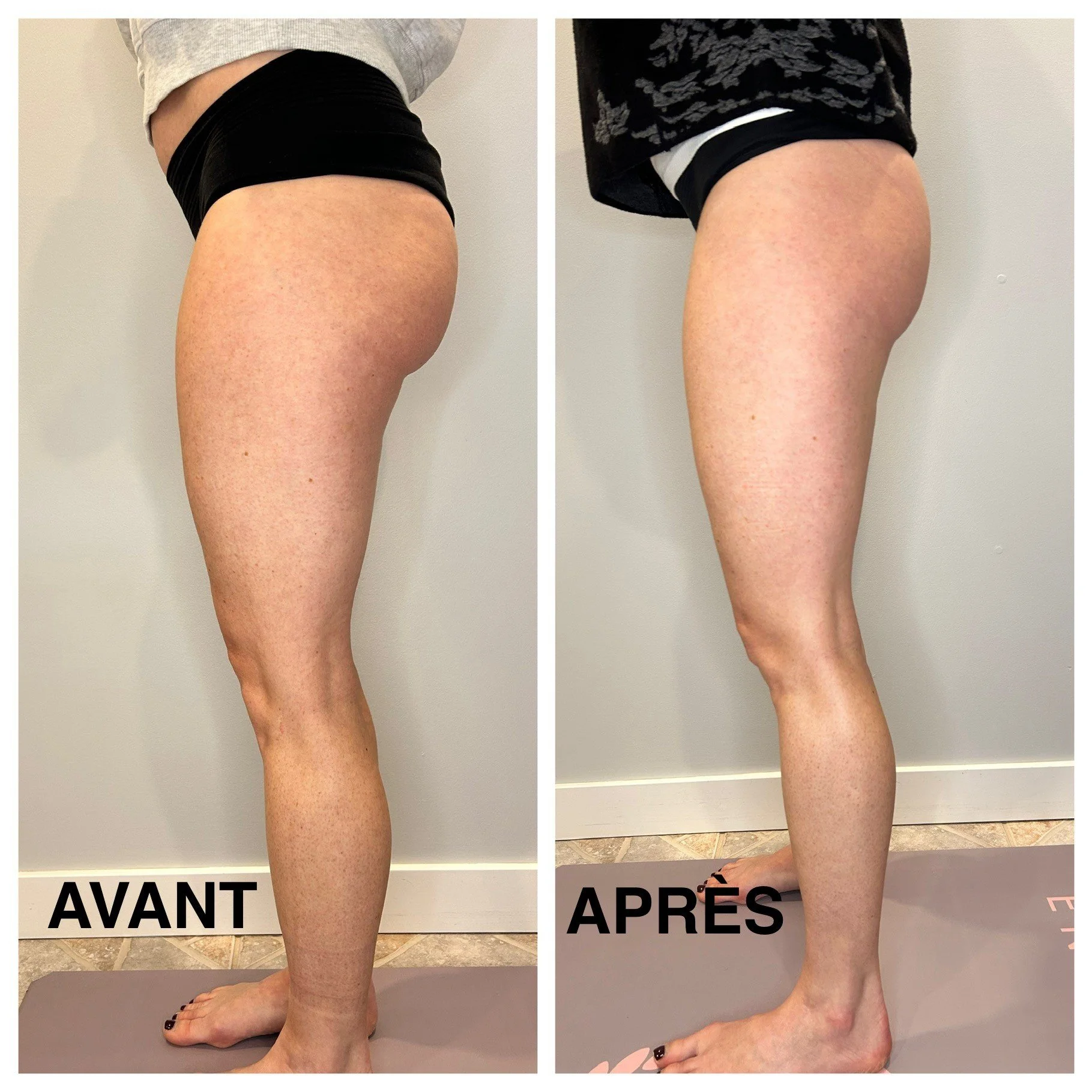 Amélie_Remodelage-Fesses-Côté.jpg