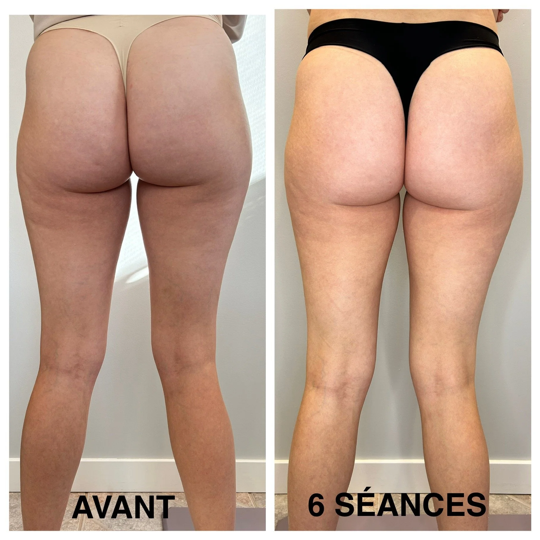 Johany_Fesses_6-séances.jpg