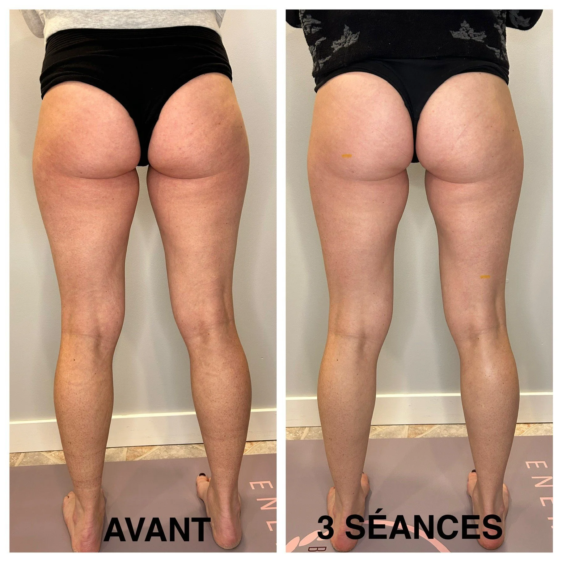 Amélie_Remodelage-Fesses-3séances.jpg