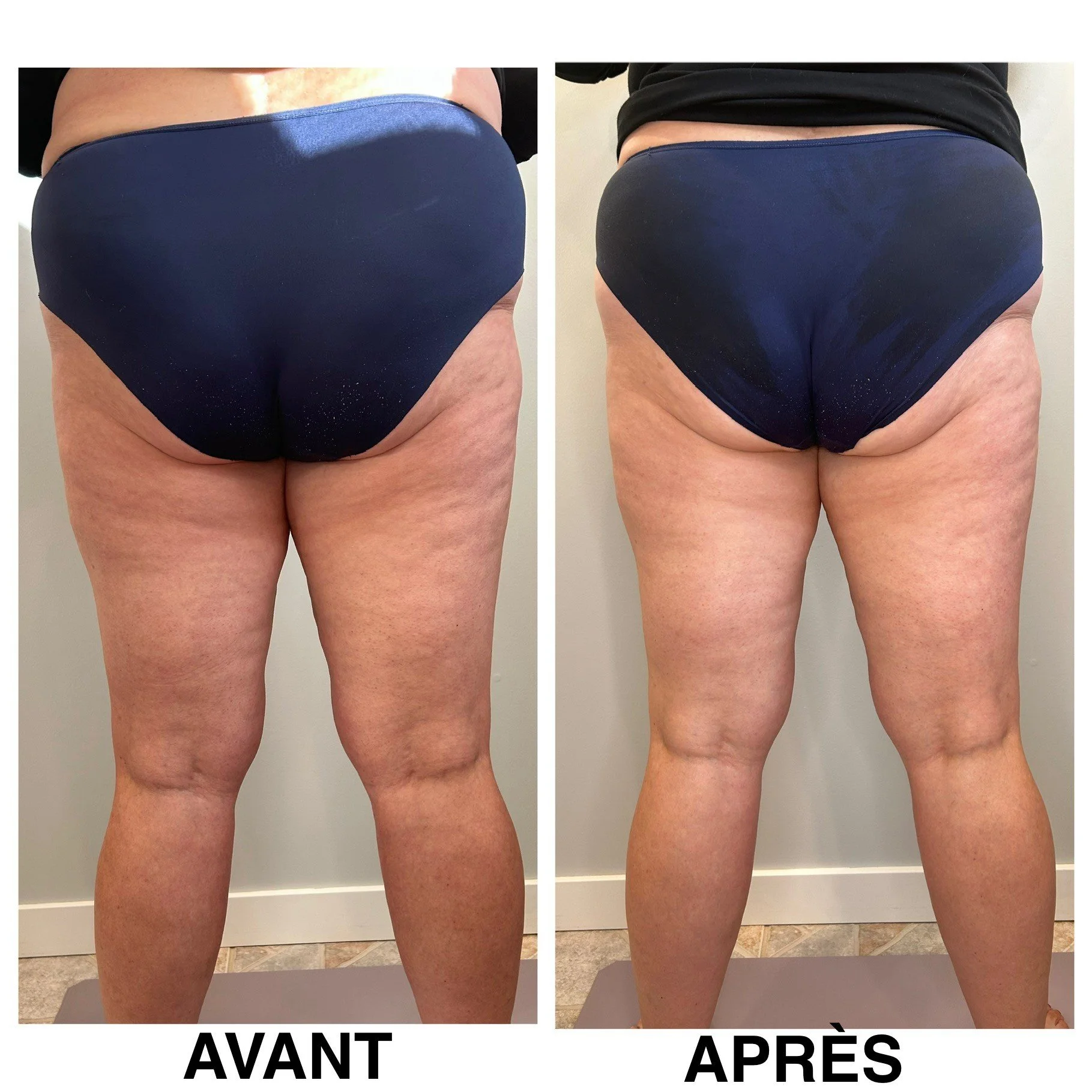 Natahlie_Cellulite_1séance.jpg