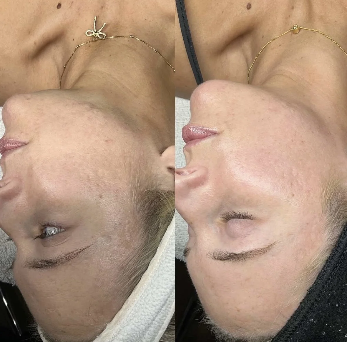 1 SkinPen Microneedling, Neurotoxin, and a targeted skincare protocol