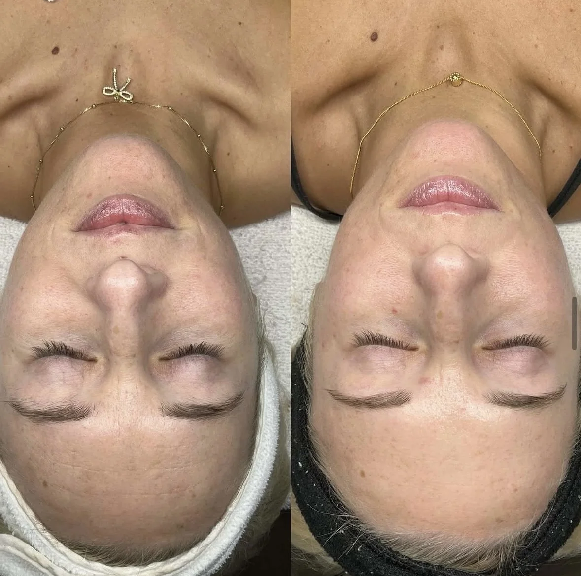 1 SkinPen Microneedling, Neurotoxin, and a targeted skincare protocol