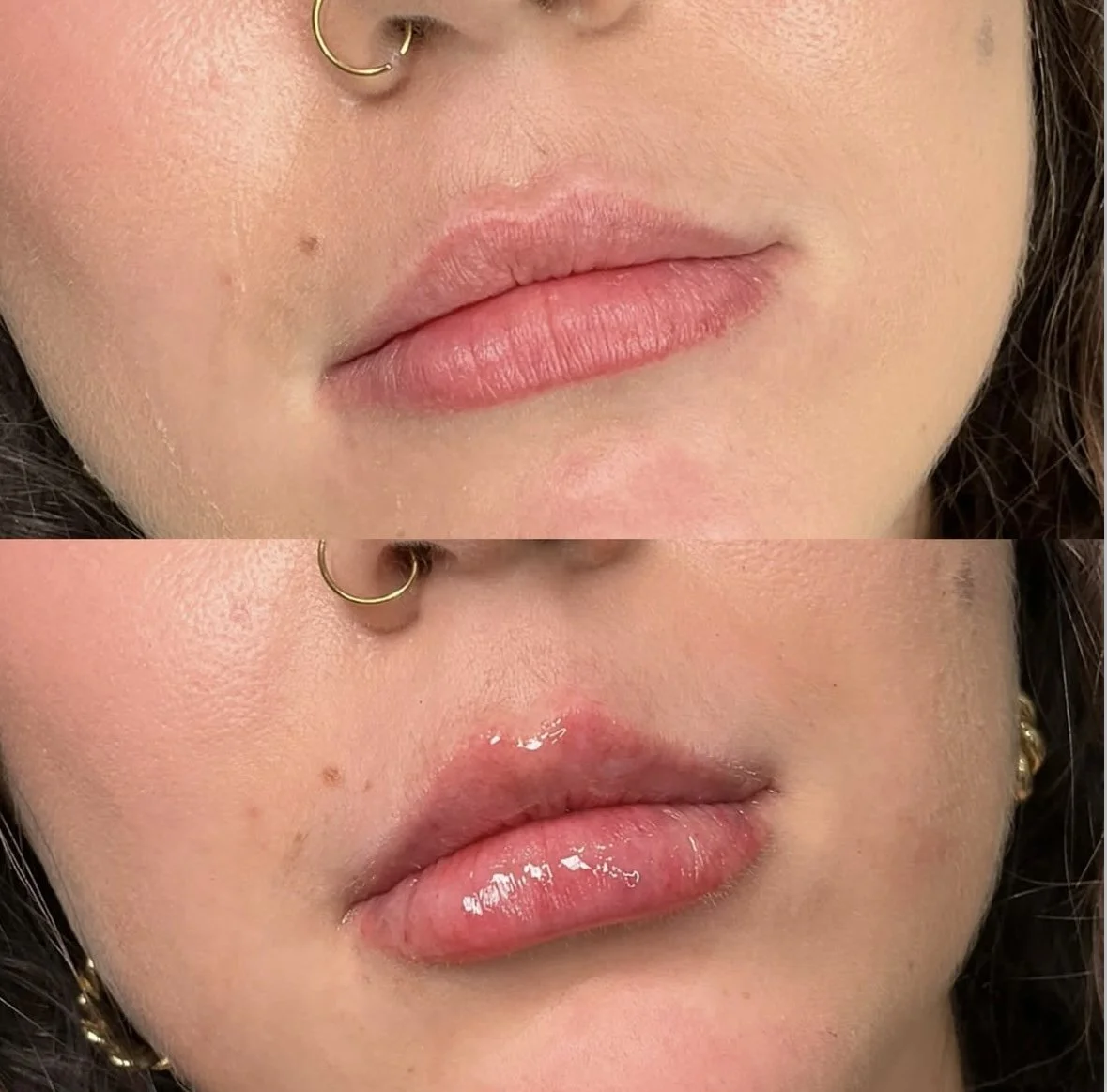 Lip Filler