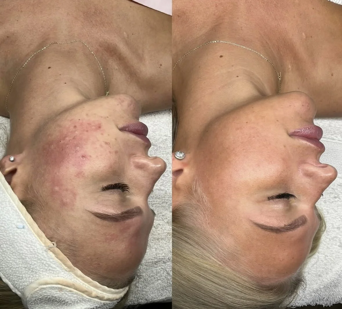 Acne Treatment