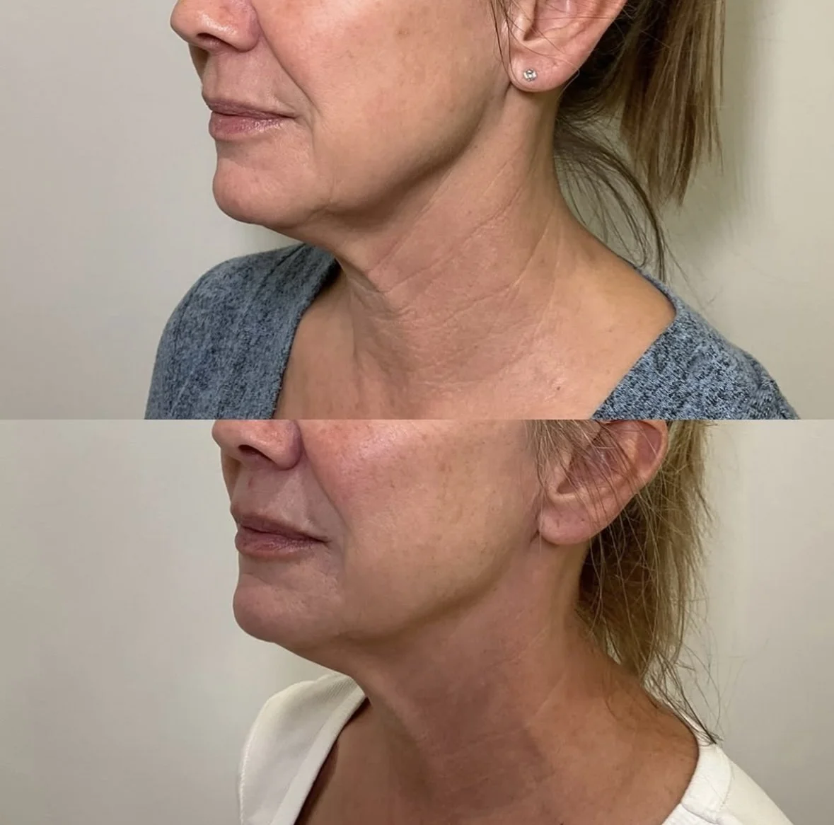Scarlet RF Microneedling