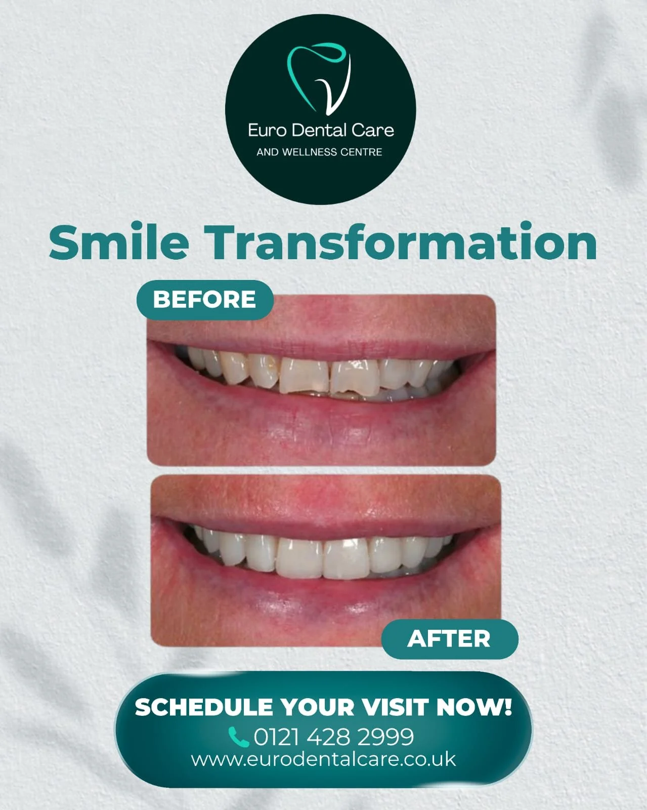 ✨ 𝗖𝗼𝗺𝗽𝗼𝘀𝗶𝘁𝗲 𝗕𝗼𝗻𝗱𝗶𝗻𝗴 𝗦𝗺𝗶𝗹𝗲 𝗧𝗿𝗮𝗻𝘀𝗳𝗼𝗿𝗺𝗮𝘁𝗶𝗼𝗻 ✨

See the difference composite bonding can make. This cosmetic dental treatment can improve the shape, symmetry, and appearance of your teeth, creating a natural and confide