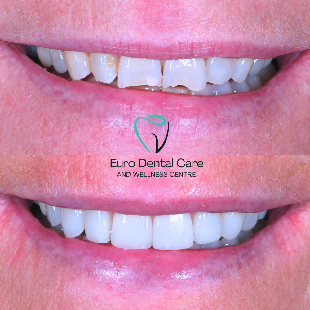 What Is Composite Bonding in Dentistry? Benefits &amp; Costs