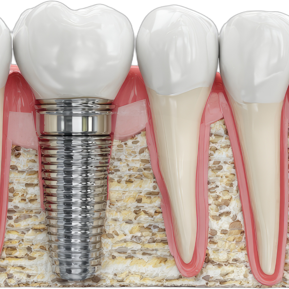 Close-up illustration of dental procedures, showing an implant-supported crown, natural tooth, and tooth root within the gums and jawbone.