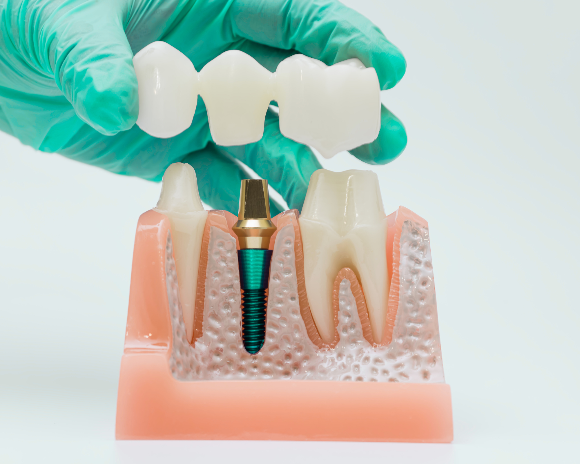 dental implant representation