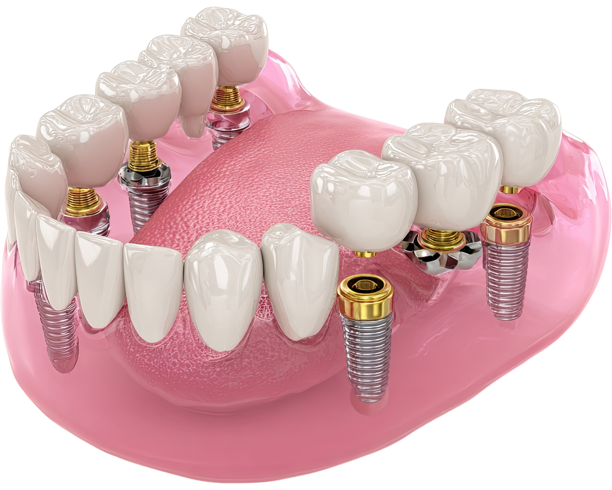 dental implant model representation