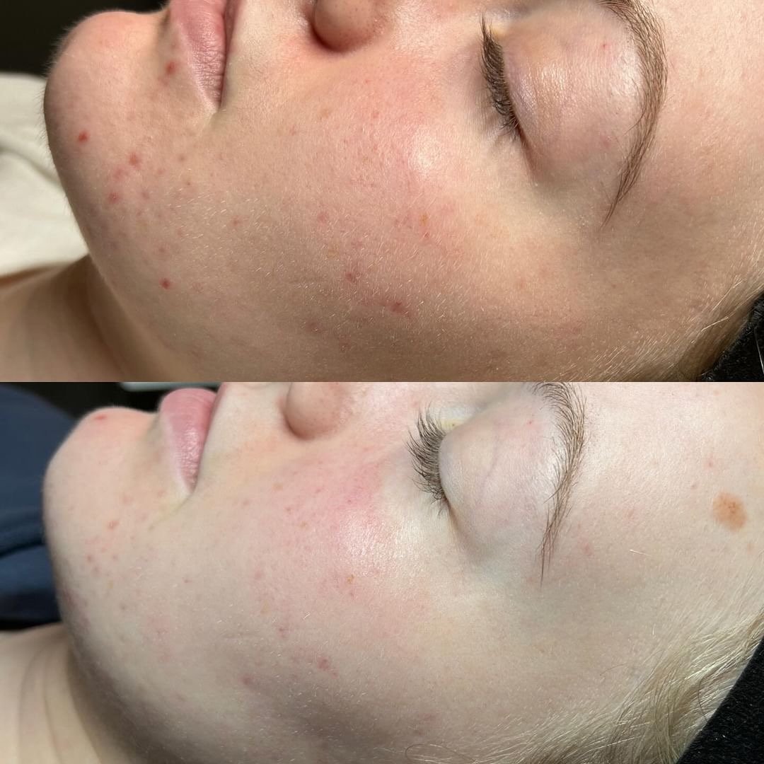 3 NeoSkin Rejuvenation Laser| Brooke Newsome
.
.
.
.
 #glomassage #gloluxuryspa #glonails #thebeautylife #skincare #staygoldenskin #facial #facialtreatement #esthylife #skin #skincareroutine #stillwaterspa #stillwaterok #stillwater #skinlaser #aerola