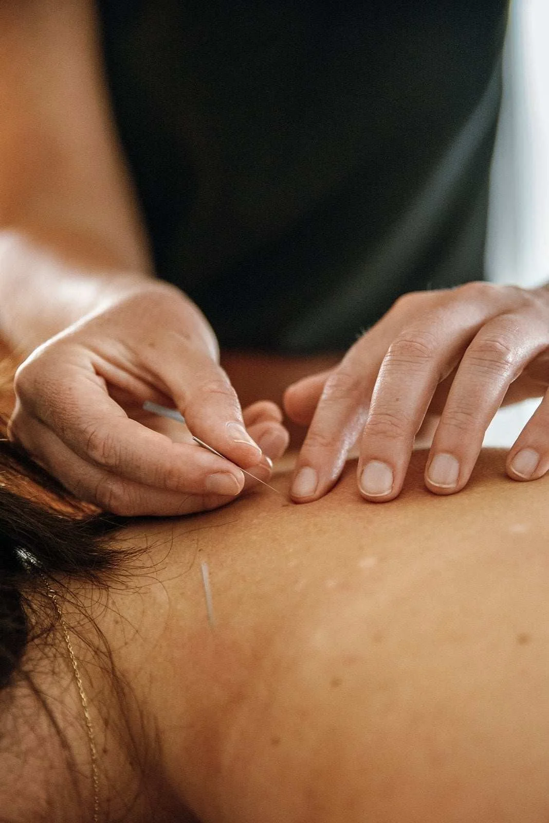 A acupuncturist in Burleigh Heads inserts an acupuncture needle into a patients back.