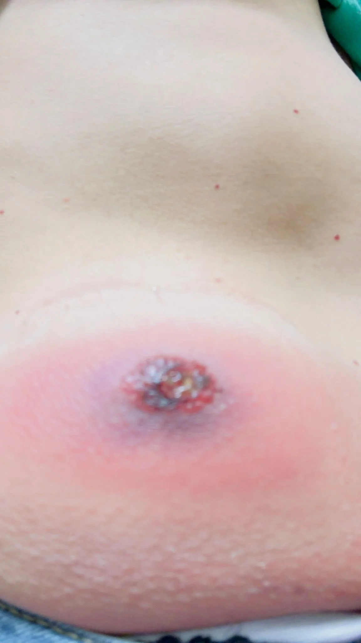 Well, originally I thought I got bitten by something and then it got really infected, but after 2 emergency department visits and hands down, no contest, the most violently painful cleaning and removal of puss anyone could possibly imagine I'm thinki