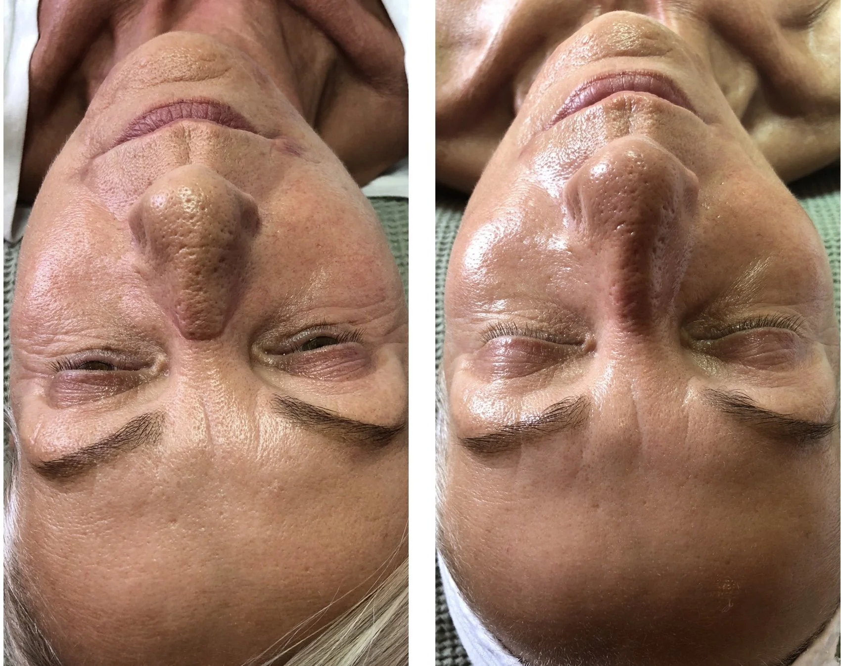 før_efter_3xneedling.JPG