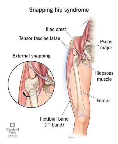 An anatomy drawing showing the cause of snapping hip