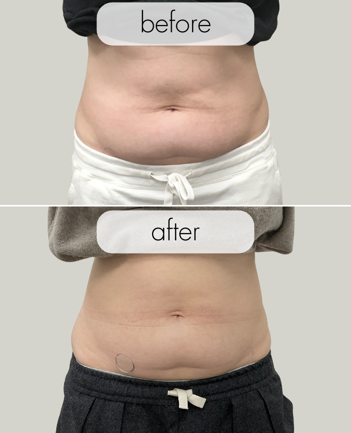 Non-Surgical Body Sculpting in Portland, Oregon: BodySculp & BodyTone ...