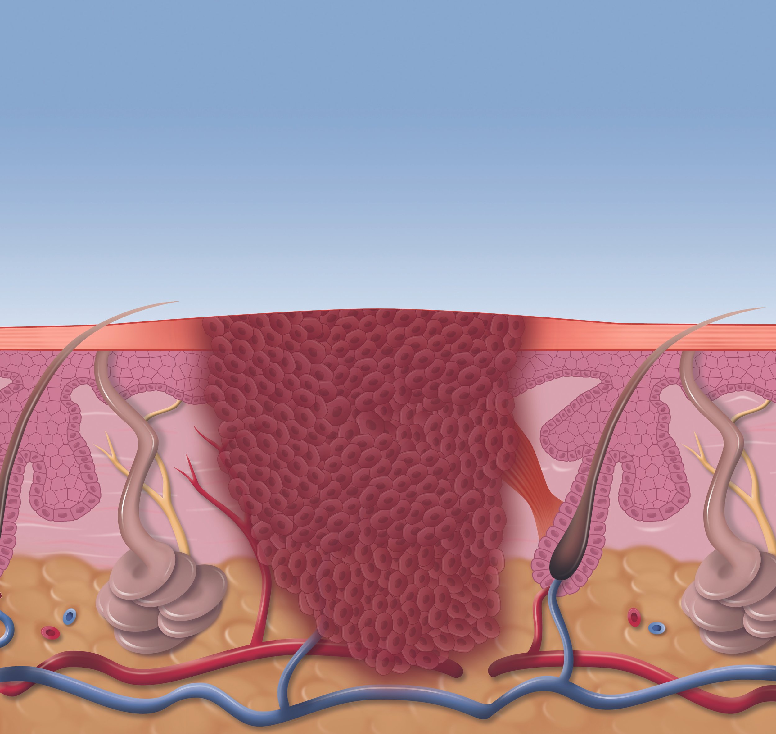 Infected Warty Tissue