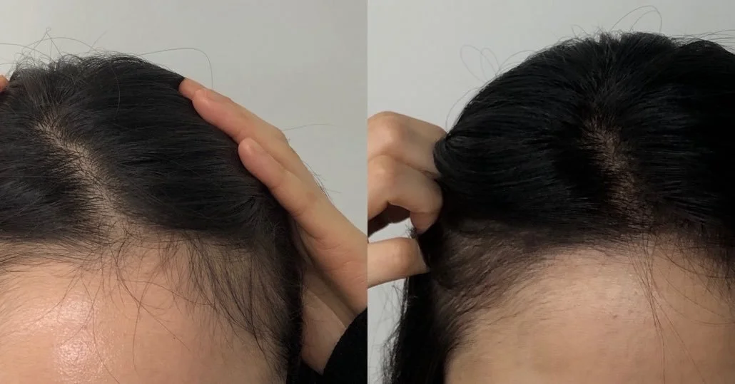 ✨ **Transform Your Hair Today!** ✨

🌟 Our SMP service is designed to help you achieve fuller, more vibrant hair that you&rsquo;ll love showing off.

Check out these real results! With an almost immediate effect, you too can experience a dramatic imp