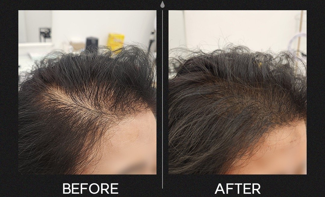 Comparison of a person's scalp before and after hair treatment showing increased hair density and coverage.