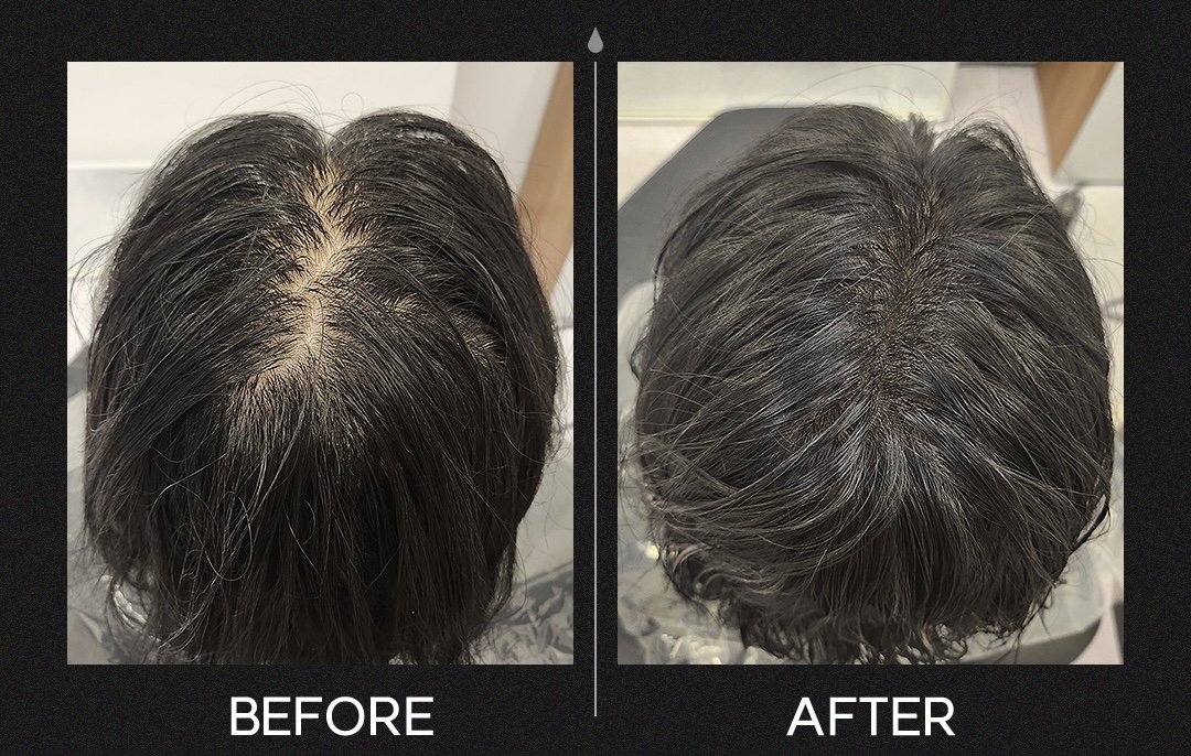Comparison of a person's scalp before and after hair treatment, showing improved hair density and reduced scalp visibility.