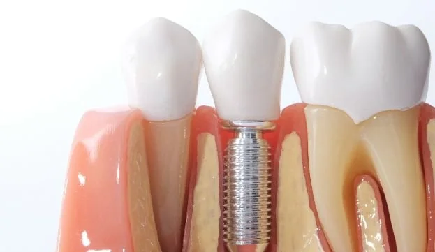 How Long Do Dental Implants Last?
