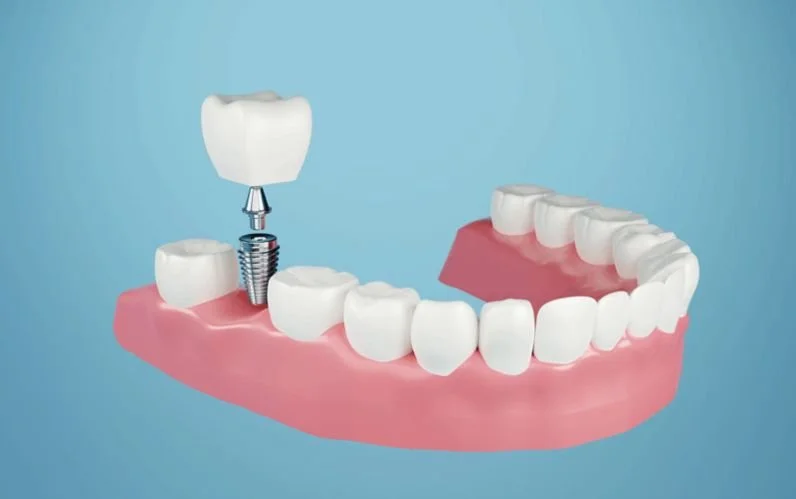 The Step by Step Process of Getting Dental Implants