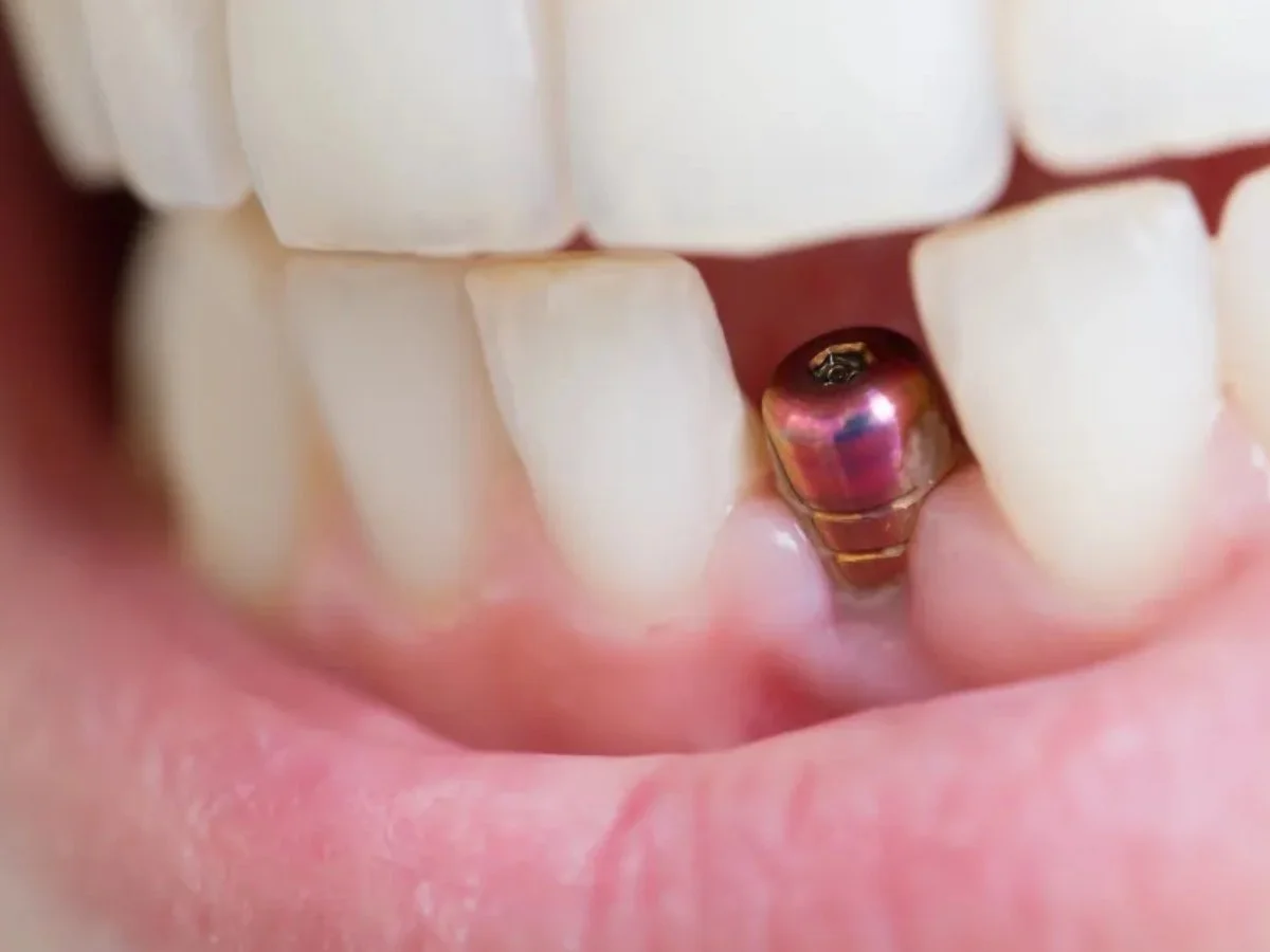 How Painful Are Dental Implants? What Patients Should Know