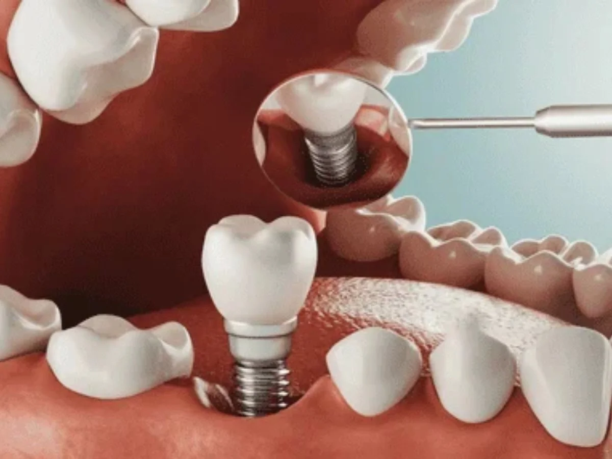 Dental Implants for Single Missing Teeth vs Multiple Teeth