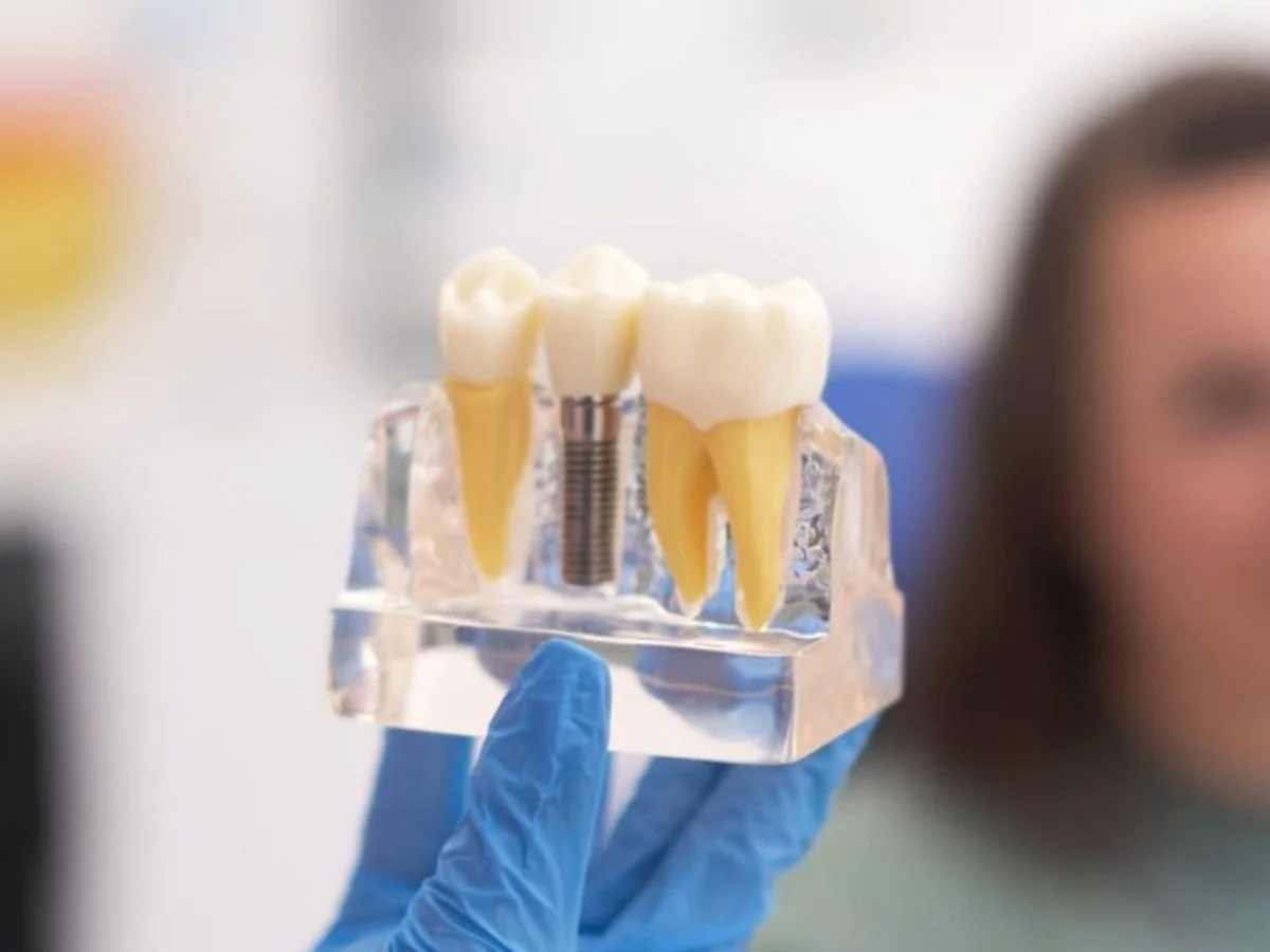 How to Care for Dental Implants After Surgery