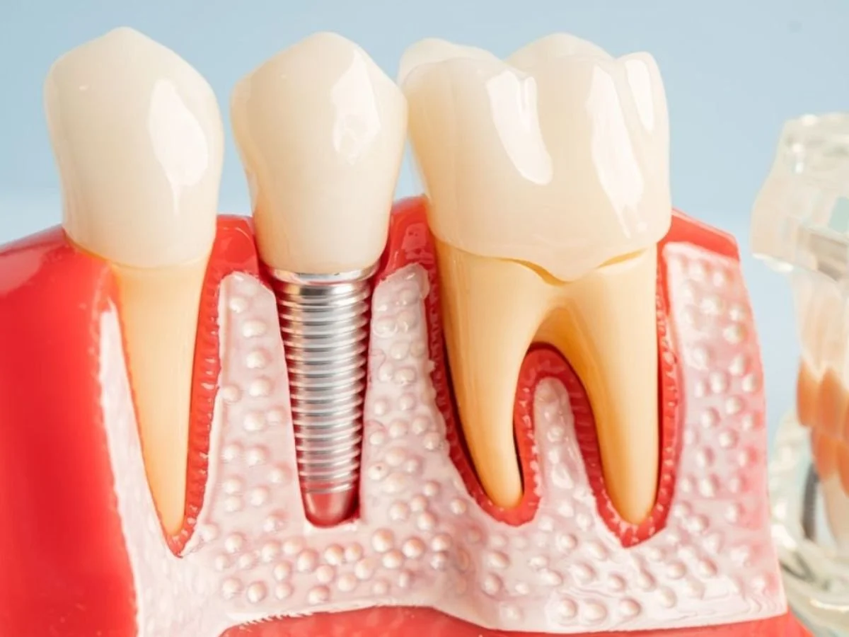 Benefits of Dental Implants Compared to Other Tooth Replacement Options