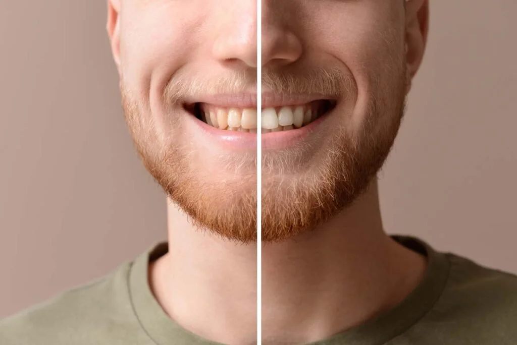 Professional Teeth Whitening vs At Home Kits