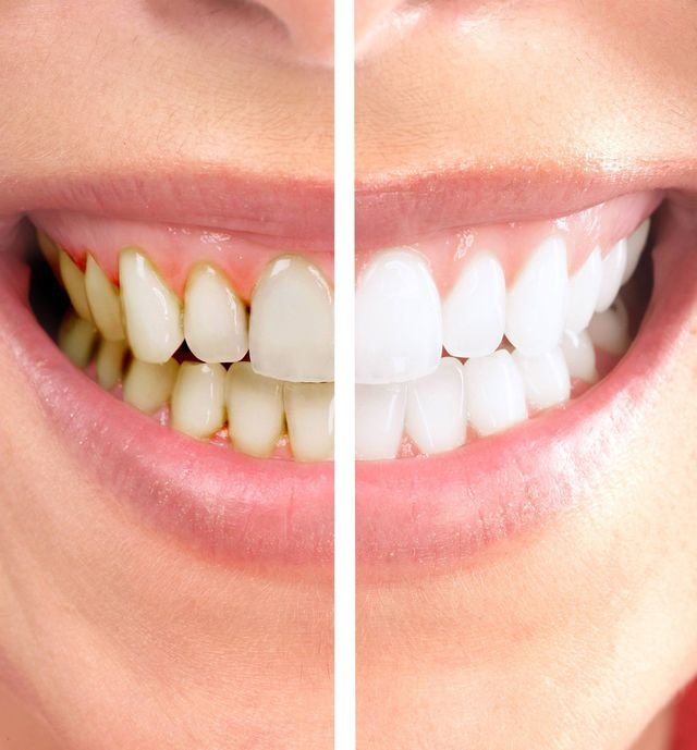 What Causes Teeth to Become Discolored Over Time?