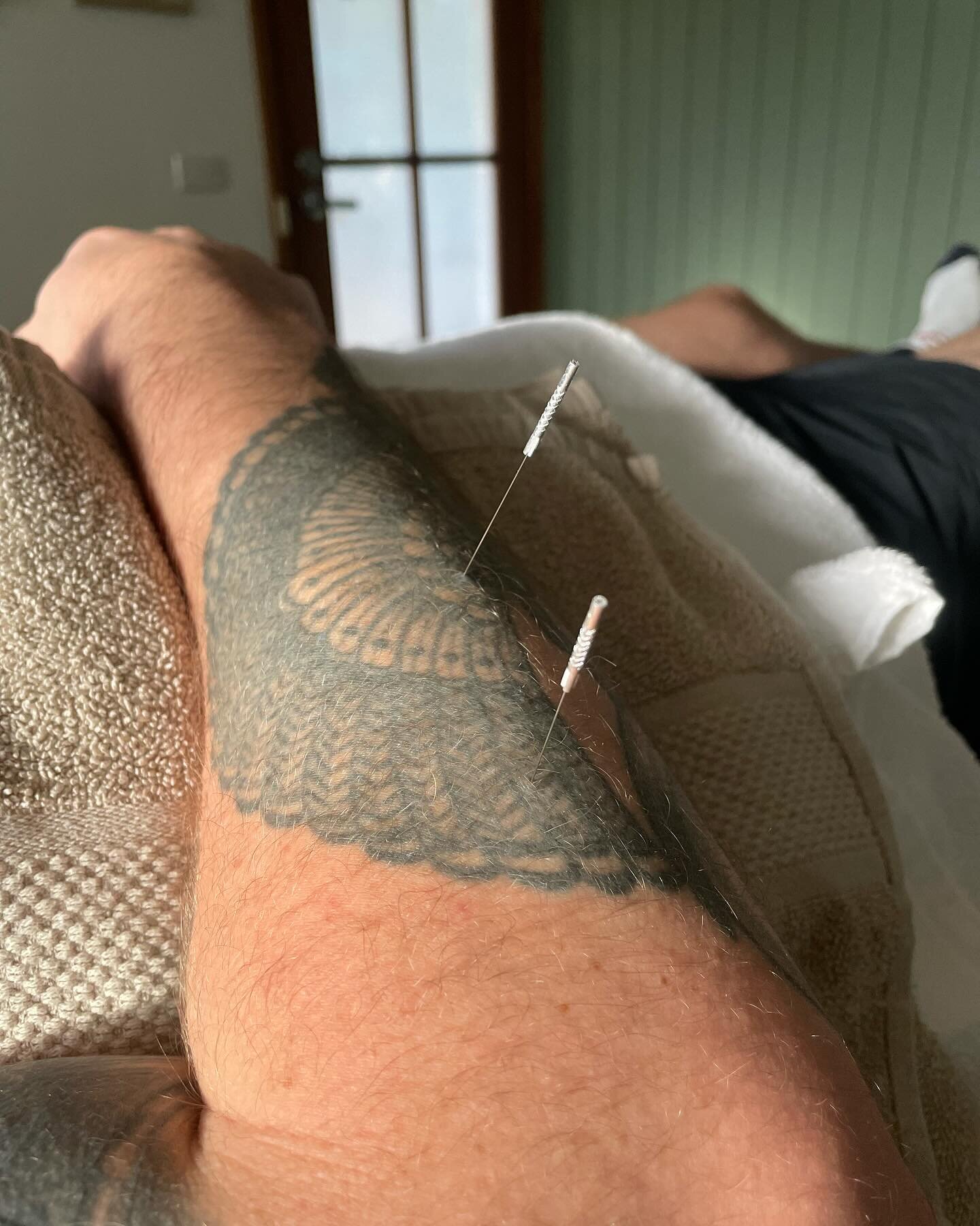 Dry needling to support the treatment of repetitive strain injuries (RSI)