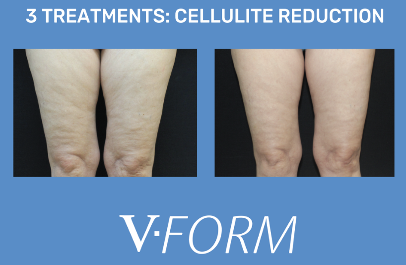 Comparison of thighs before and after cellulite reduction treatments with visible skin smoother in the after image.