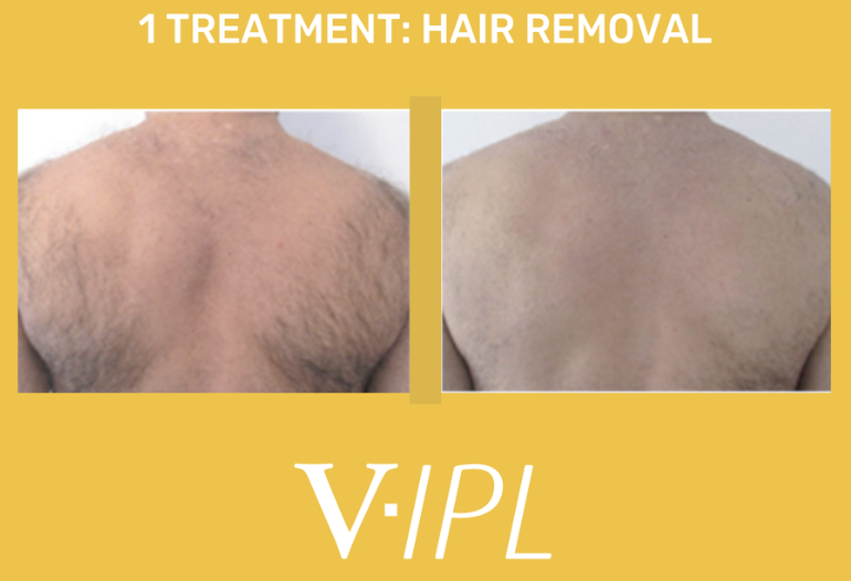 Comparison of a man's back before and after hair removal treatment, showing reduced hair on the right side, with text indicating '1 Treatment: Hair Removal' and branding 'V-IPL'.