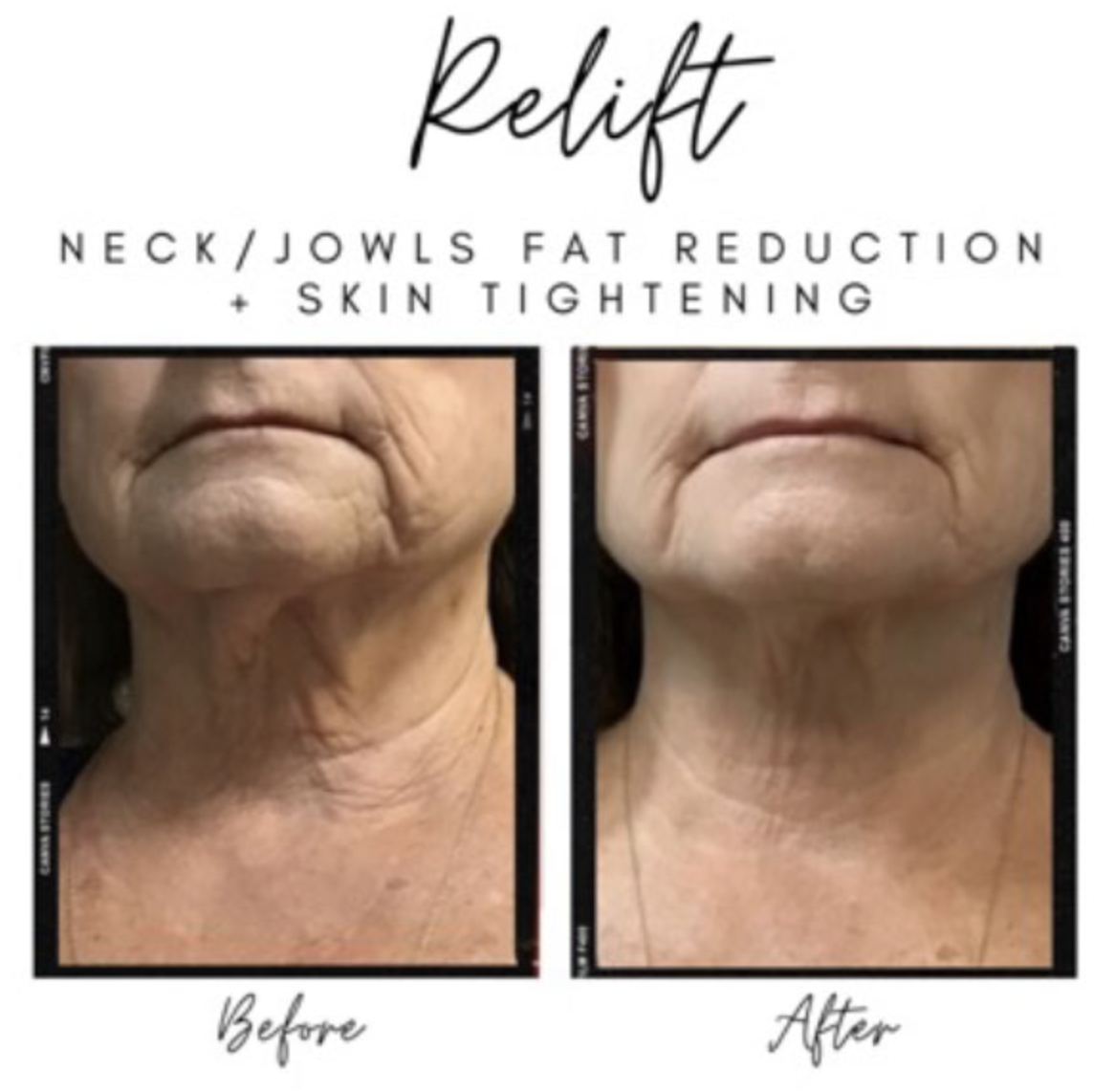 Comparison of a woman's neck and jawline before and after using a skin treatment. The 'before' side shows sagging skin and wrinkles, while the 'after' side shows smoother, tightened skin.