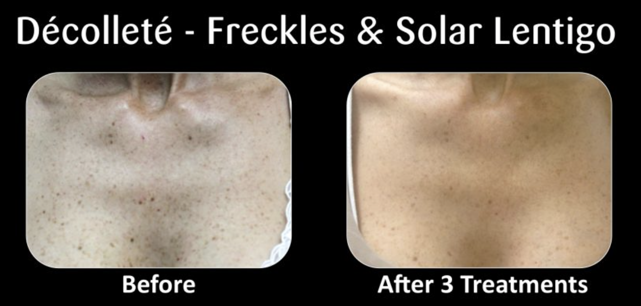 Comparison of skin on a person's chest before and after three treatments, showing reduced freckles and solar lentigo.