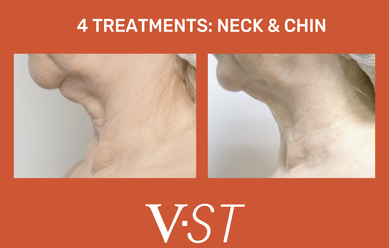 Comparison of neck and chin area before and after four treatments, showing reduced wrinkles and skin tightening.