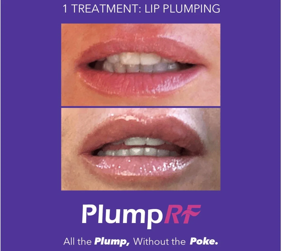 Comparison of lips before and after lip plumping treatment, showing fuller lips in the bottom image.