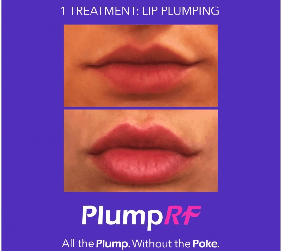 Before and after images of lips showing Lip Plumping treatment, with text indicating the treatment is for lip plumping using Plump RF, advertising a lip enhancement procedure.