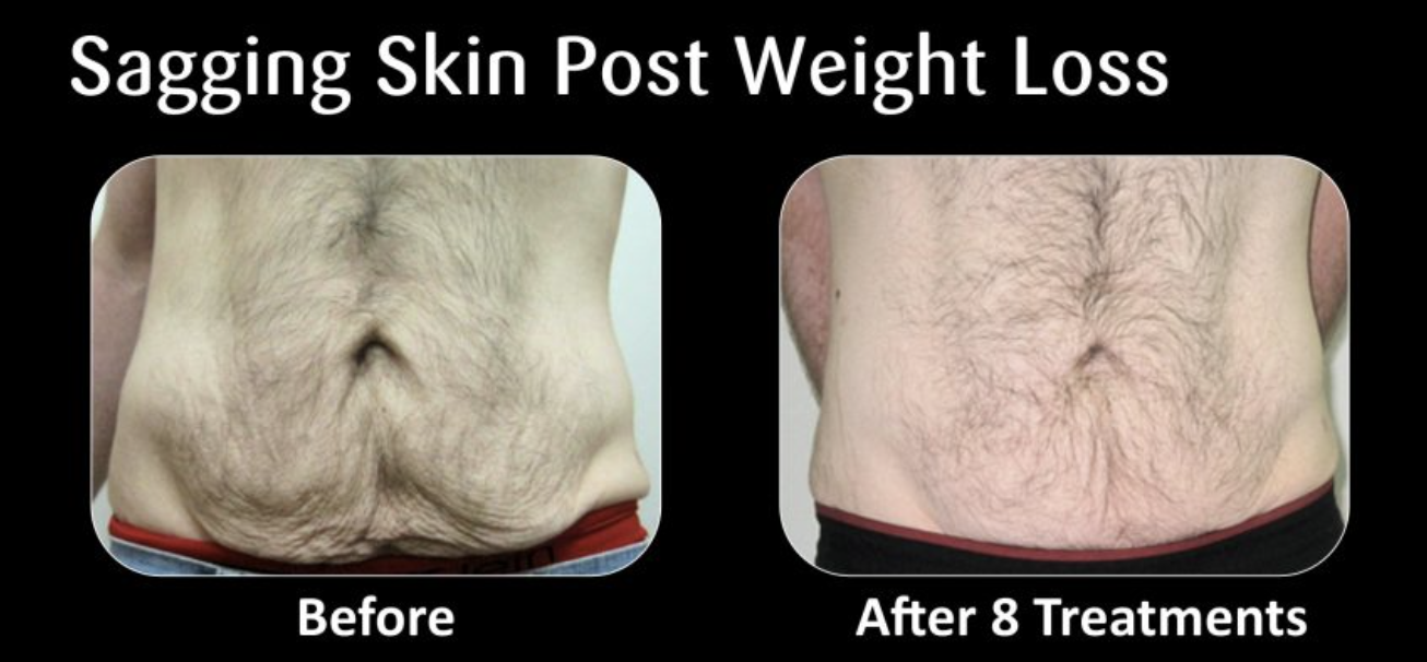 Comparison of a man's abdomen before and after 8 skin treatments, showing sagging skin reduction.