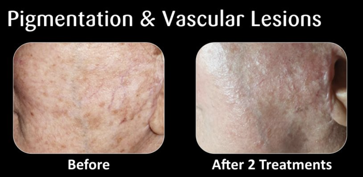 Side-by-side comparison of a person's skin showing pigmentation and vascular lesions before and after two treatments; the skin looks clearer and less pigmented after treatment.
