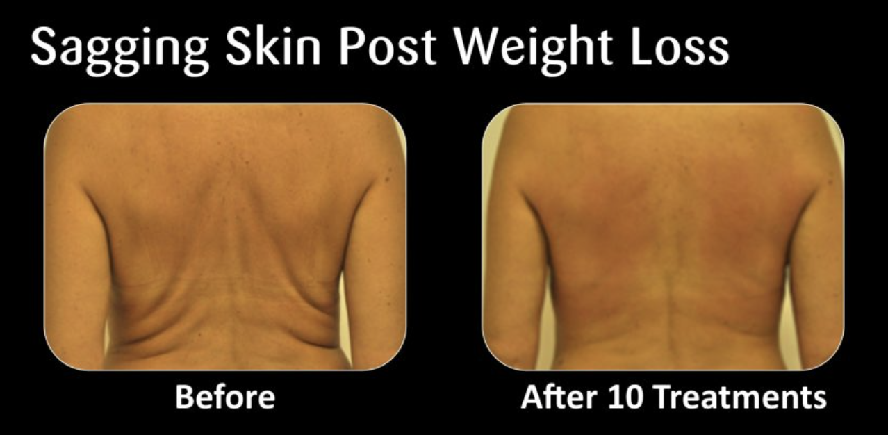 Side-by-side comparison of a person's back before and after 10 skin treatment sessions, showing reduced sagging skin and improved skin firmness.