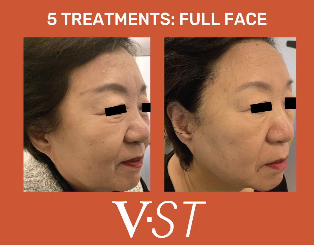 Before and after images comparing facial treatments for a woman, with text indicating '5 Treatments: Full Face' and 'V-ST'.