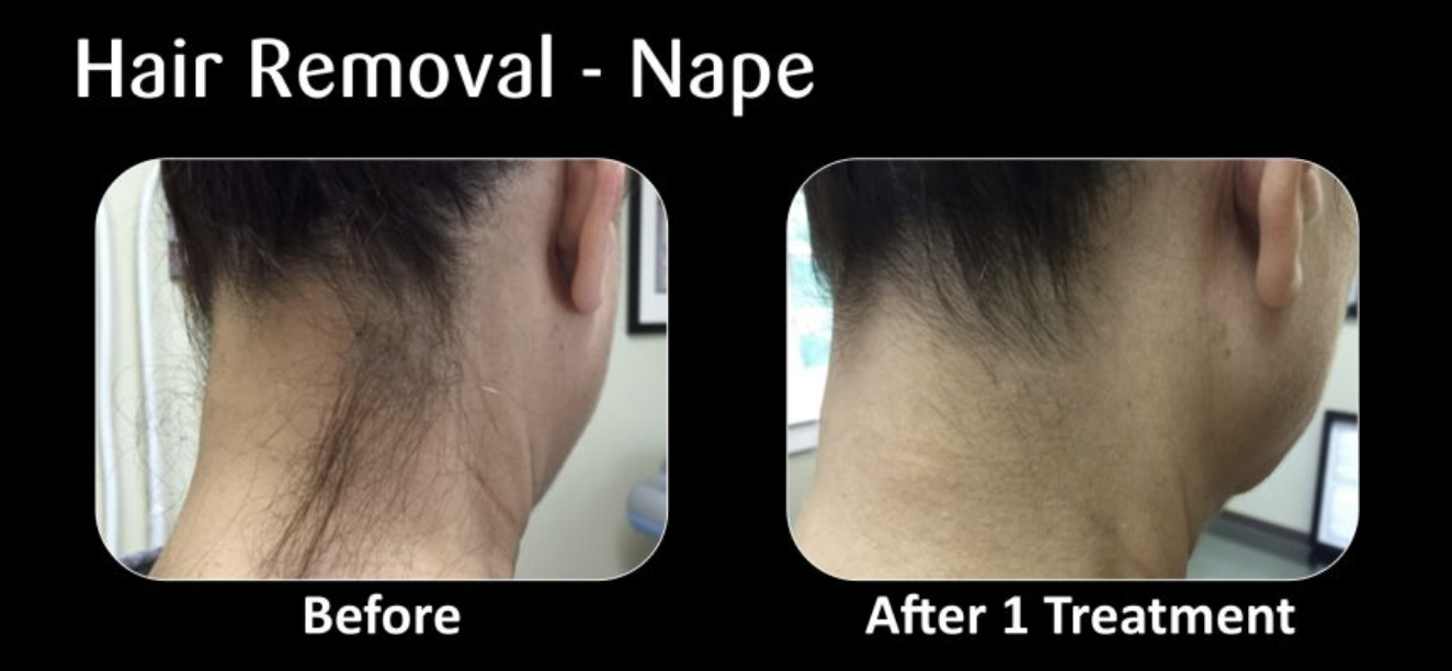 Comparison of a person's neck showing hair loss before and after one hair removal treatment. The "before" side has visible hair, while the "after" side shows smooth skin.