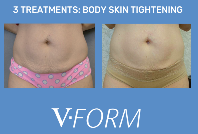 Comparison of abdomen before and after body skin tightening treatment, demonstrating improved skin firmness and reduced sagging.