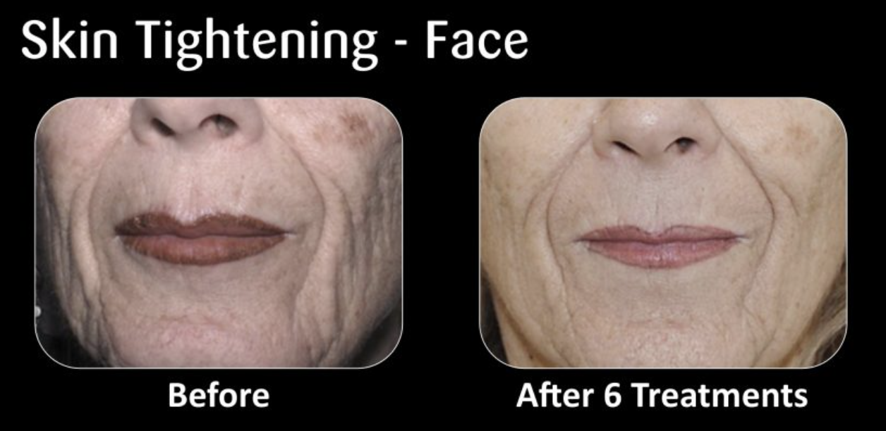 Comparison of a woman's face showing skin tightening results before and after six treatments, with visible reduction in wrinkles and sagging.