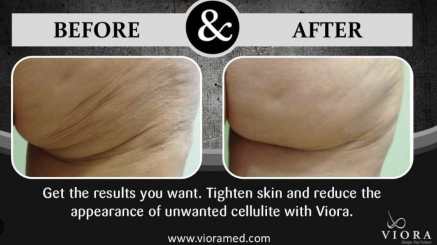 Comparison of skin before and after using Viora treatment, showing tightened and smoother skin in the after image.