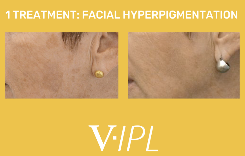 Before and after photos showing the results of a facial hyperpigmentation treatment with V:IPL, featuring close-up views of a person's cheek and ear.