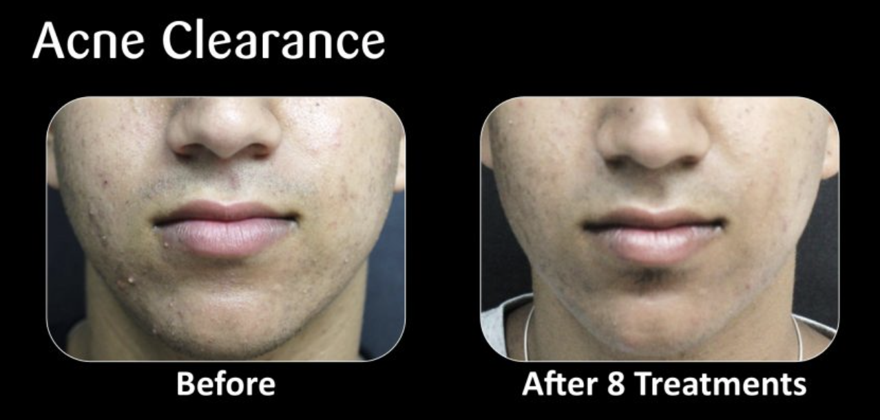 Comparison of a person's chin showing acne before and after 8 treatments, with noticeable reduction in acne and clearer skin in the after photo.